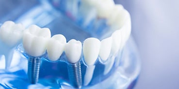 Dental Implants Image